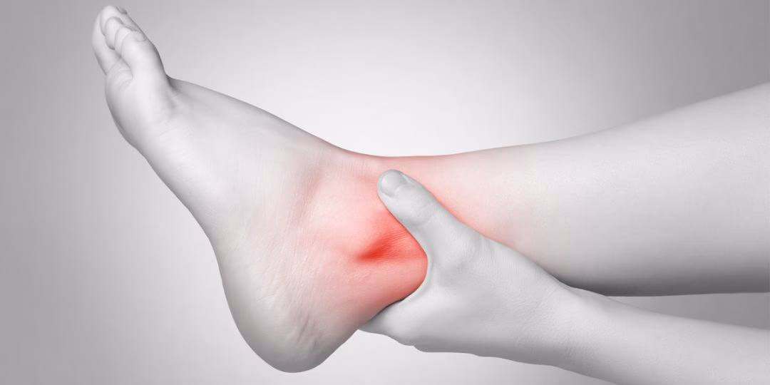 ¿Cómo quitar el dolor de la gota rápido y efectivo?