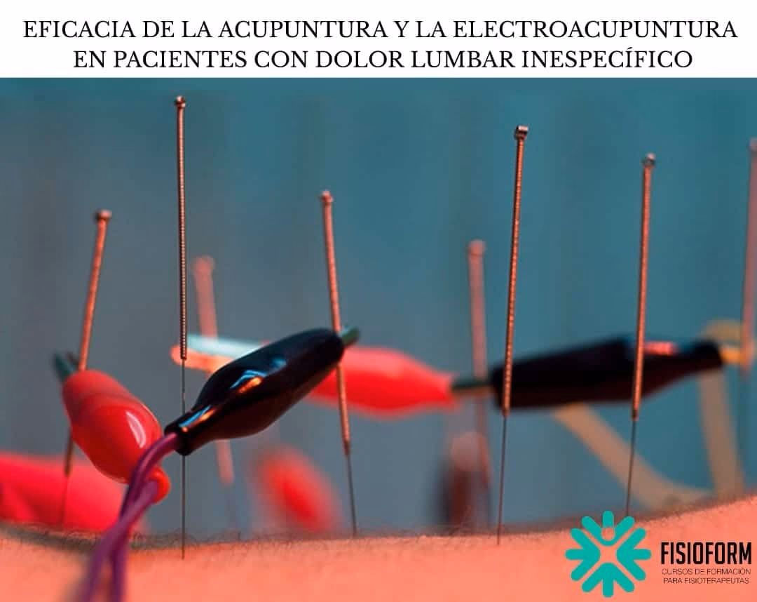 ¿Qué me puedo pinchar para el lumbago?
