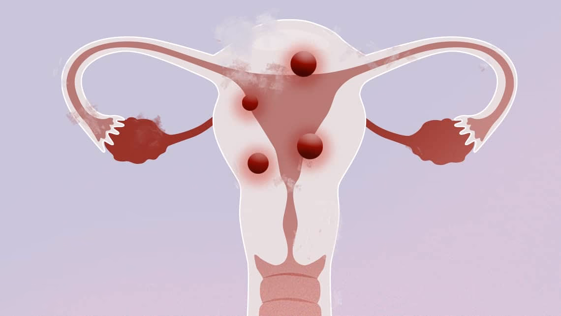 ¿Qué es bueno para disolver los miomas uterinos?