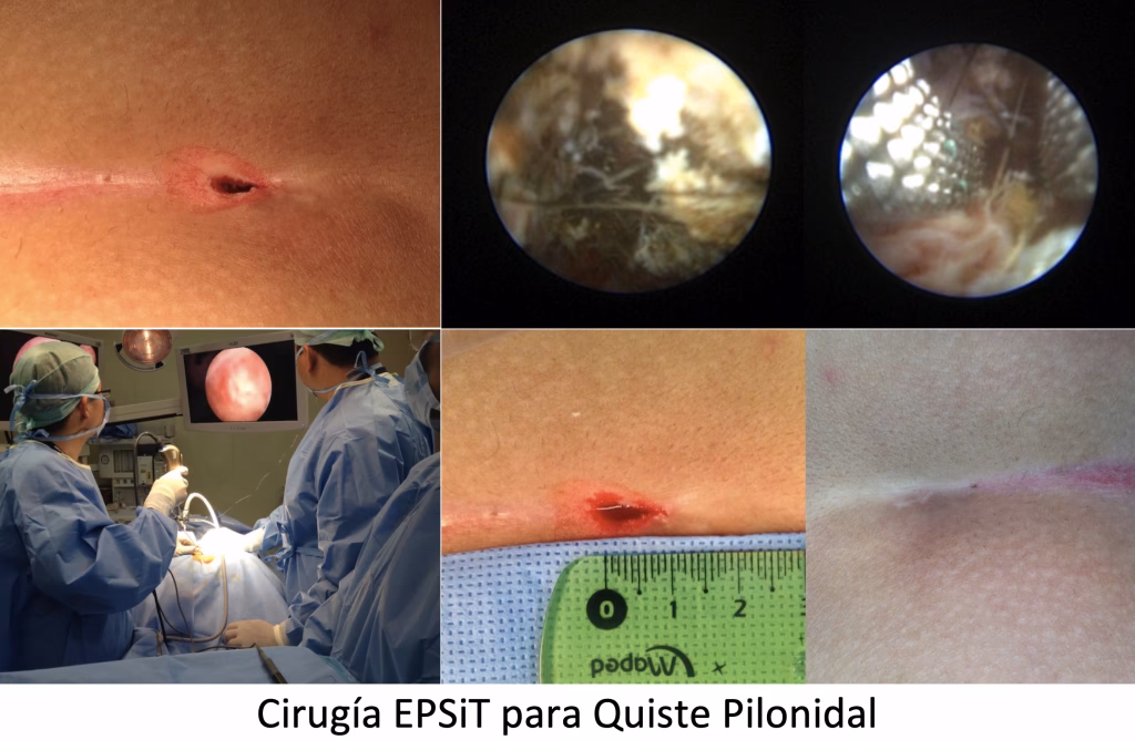 ¿Qué antibiótico es bueno para el quiste pilonidal?