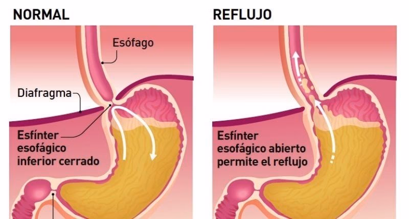 ¿Cómo relajar el esfínter esofágico inferior?