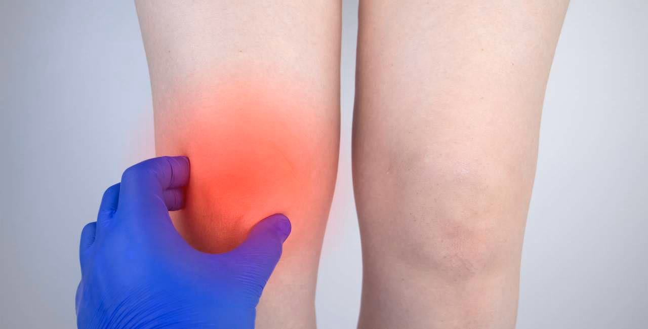 ¿Cómo acelerar la curación de un edema óseo?