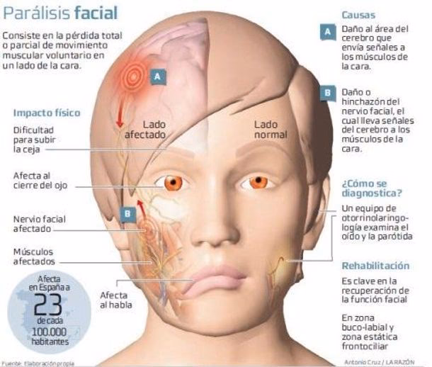¿Cuáles son los puntos de acupresión para la parálisis facial?