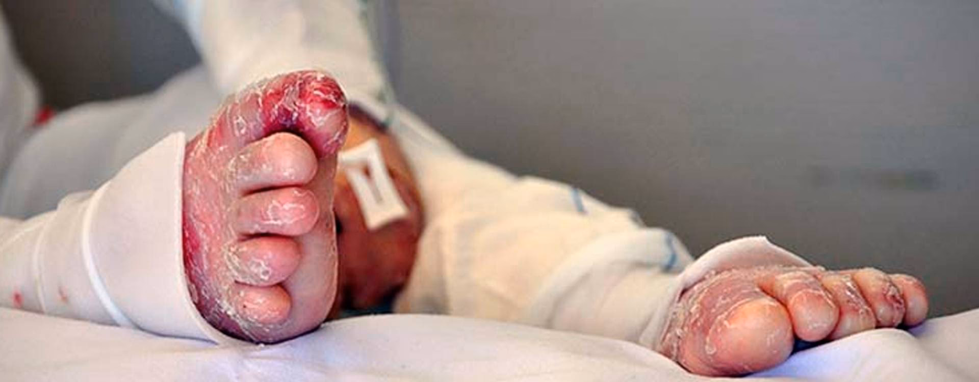 ¿Cómo saber si tienes piel de mariposa?