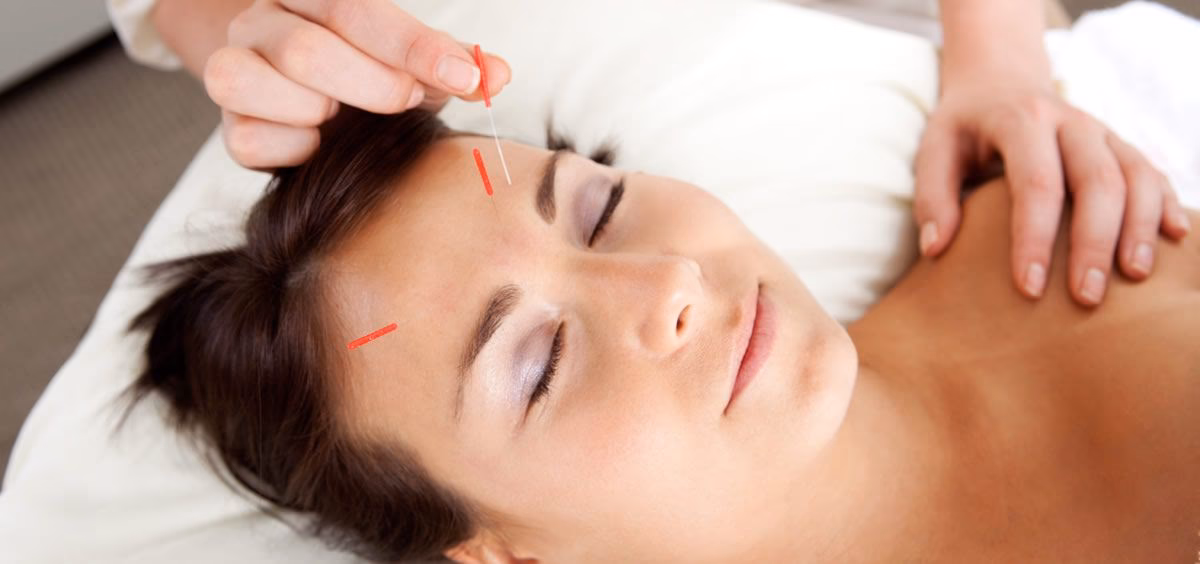 ¿Cuánto dura un lifting facial con acupuntura?