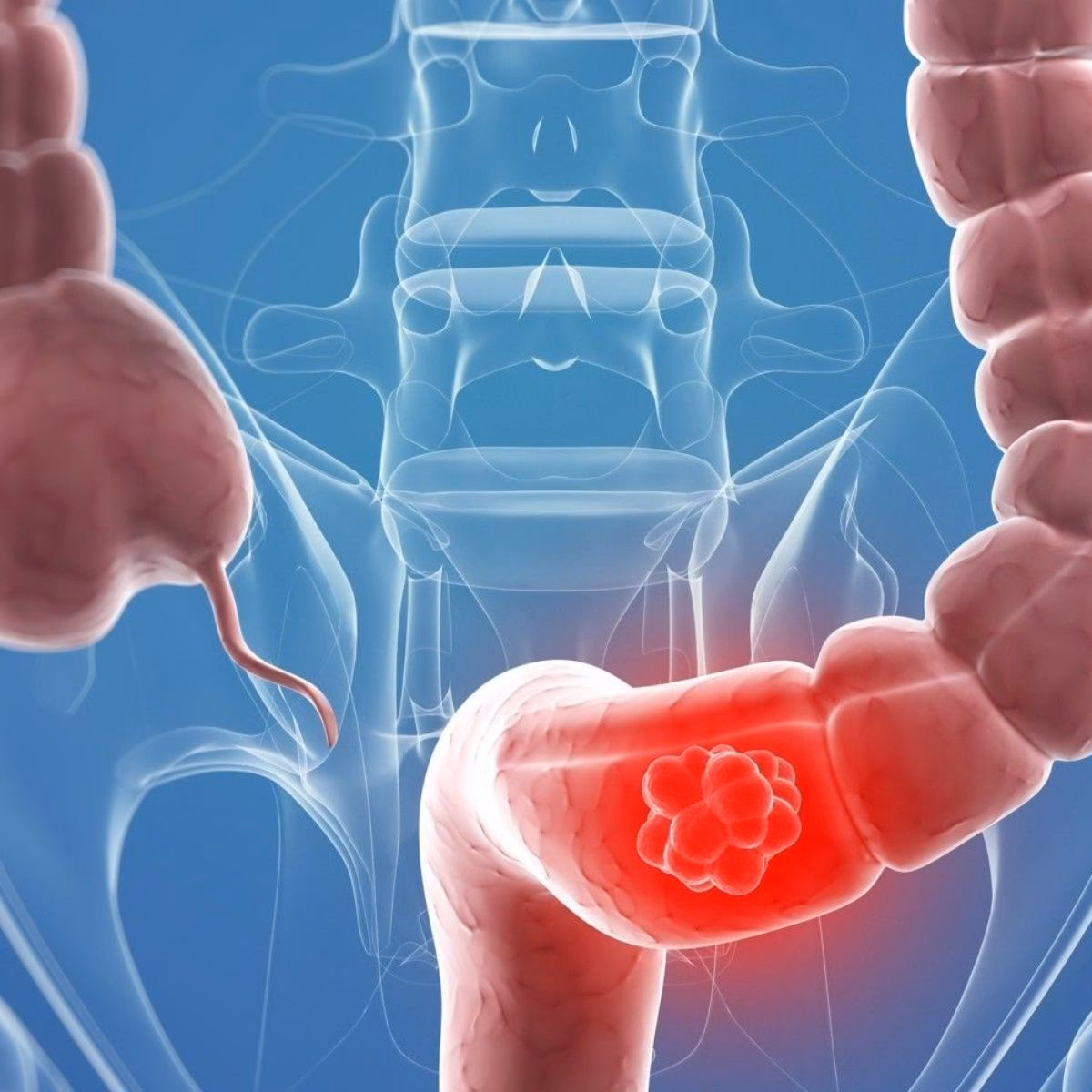 ¿Qué es bueno para parar el sangrado intestinal?