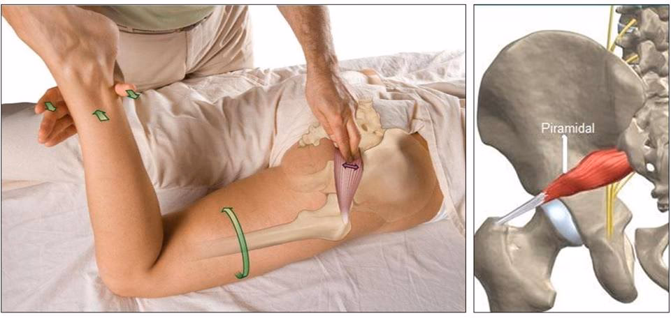 ¿La acupuntura cura el síndrome piriforme?