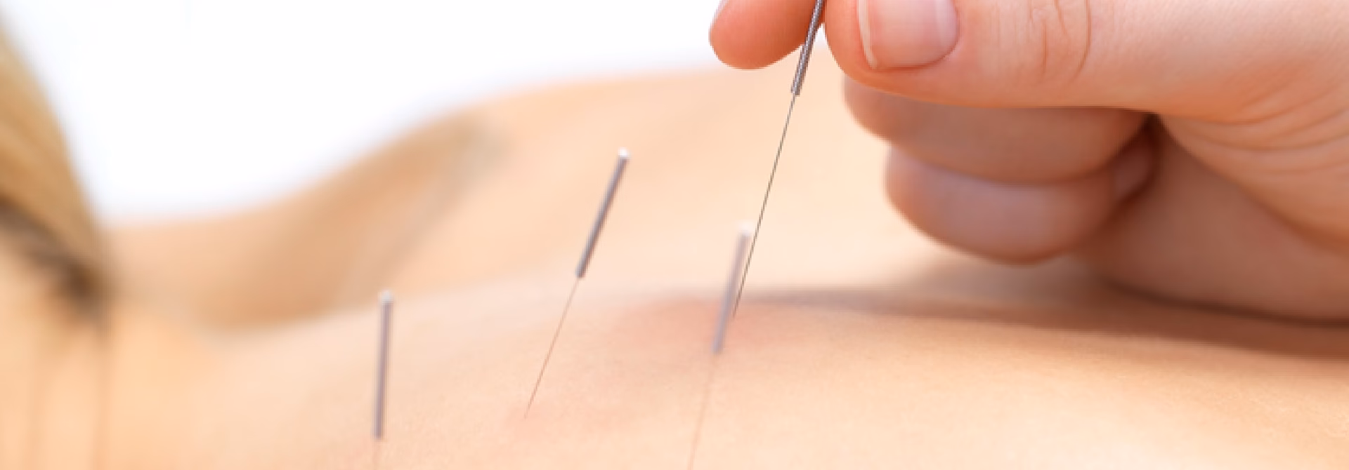 Who can practice acupuncture in Switzerland?
