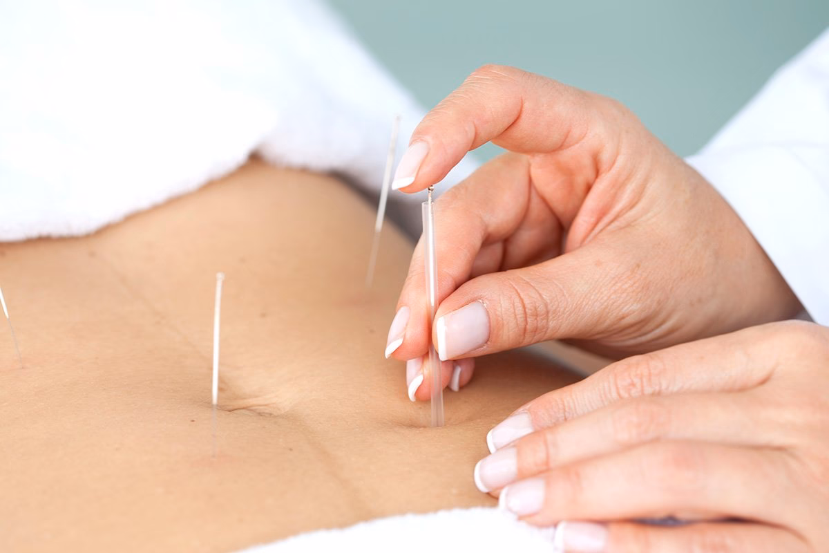 ¿Puede la acupuntura curar las trompas de Falopio bloqueadas?