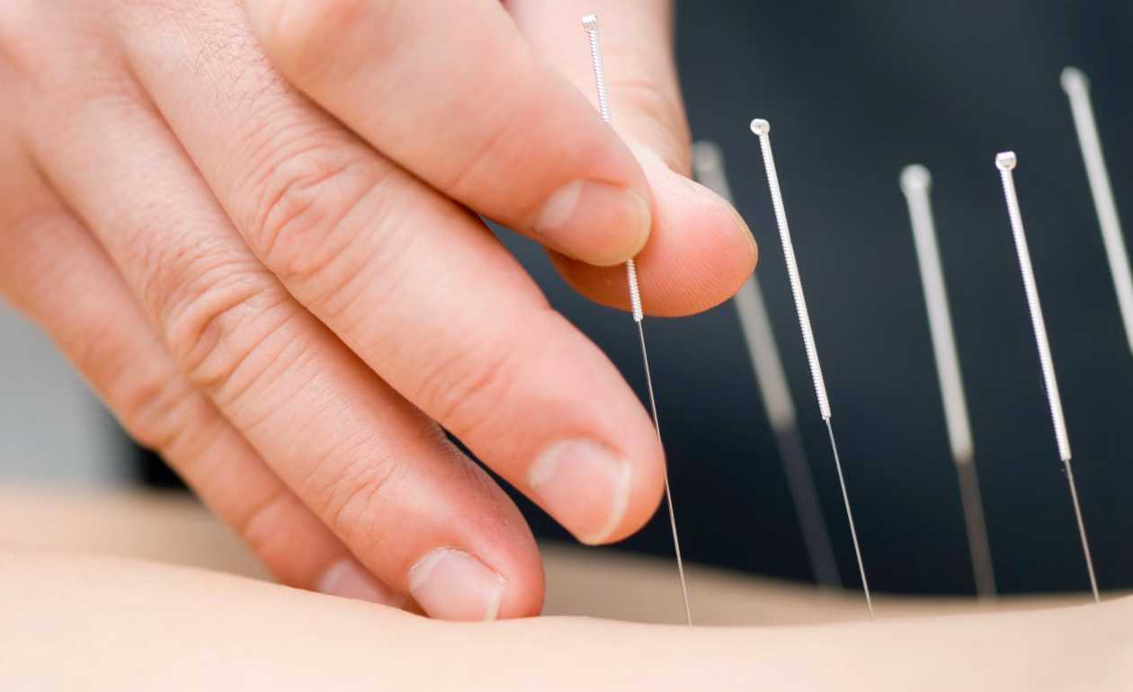 ¿Cuánto tiempo después de la acupuntura puedo empezar a nadar?