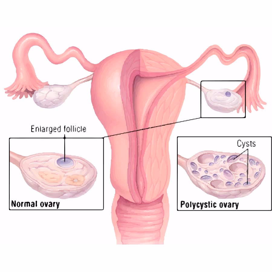 ¿Cómo desinflamar el ovario poliquístico?