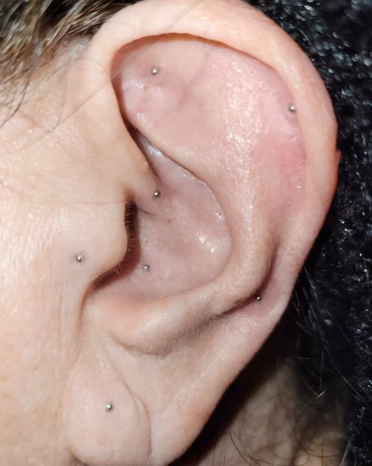 How do you remove acupuncture ear seeds?