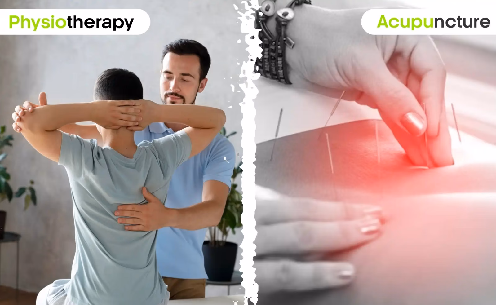 Do physios do dry needling or acupuncture?