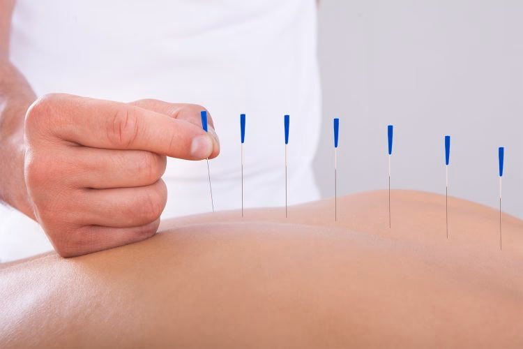 Is acupuncture considered physiotherapy?