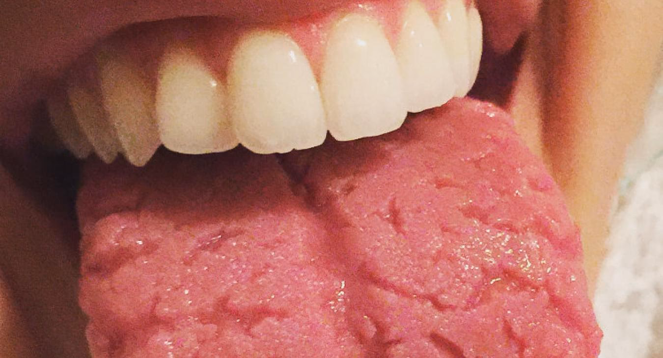 How do you calm a burning mouth syndrome?