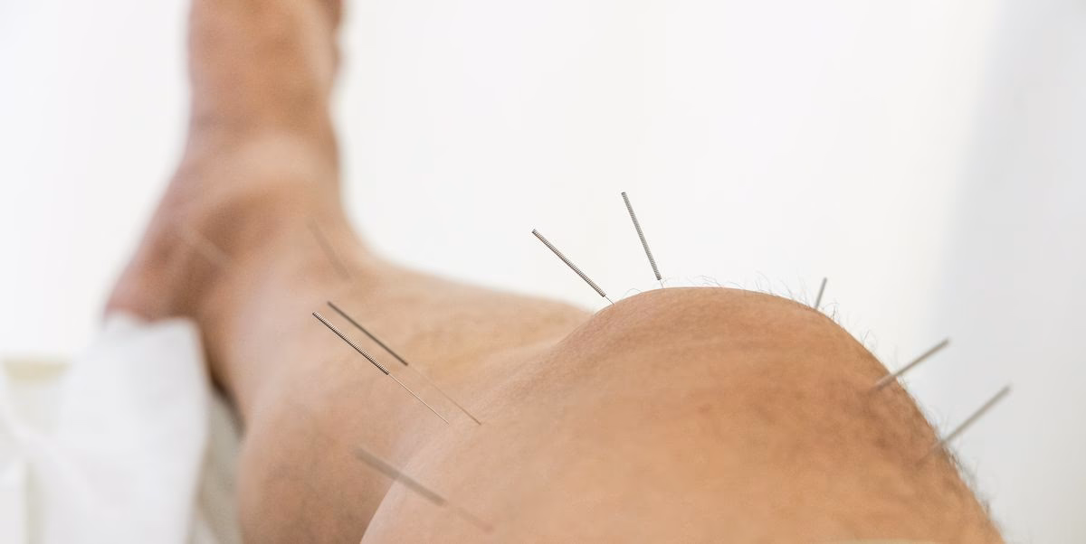 Does acupuncture release lactic acid?