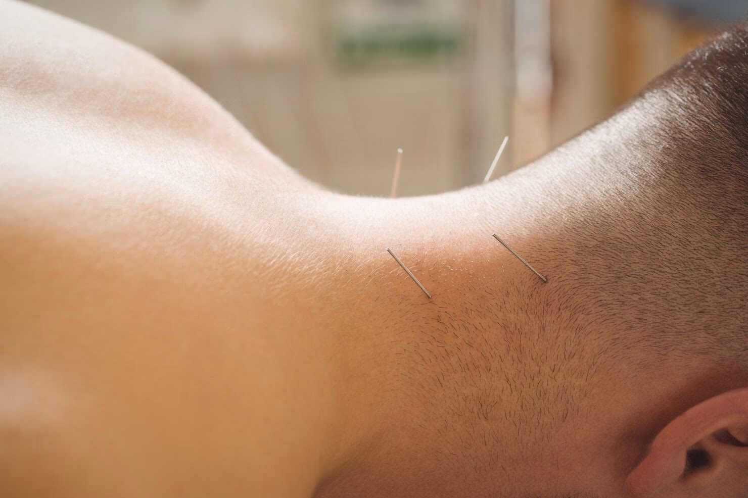 Can acupuncture heal a stiff neck?