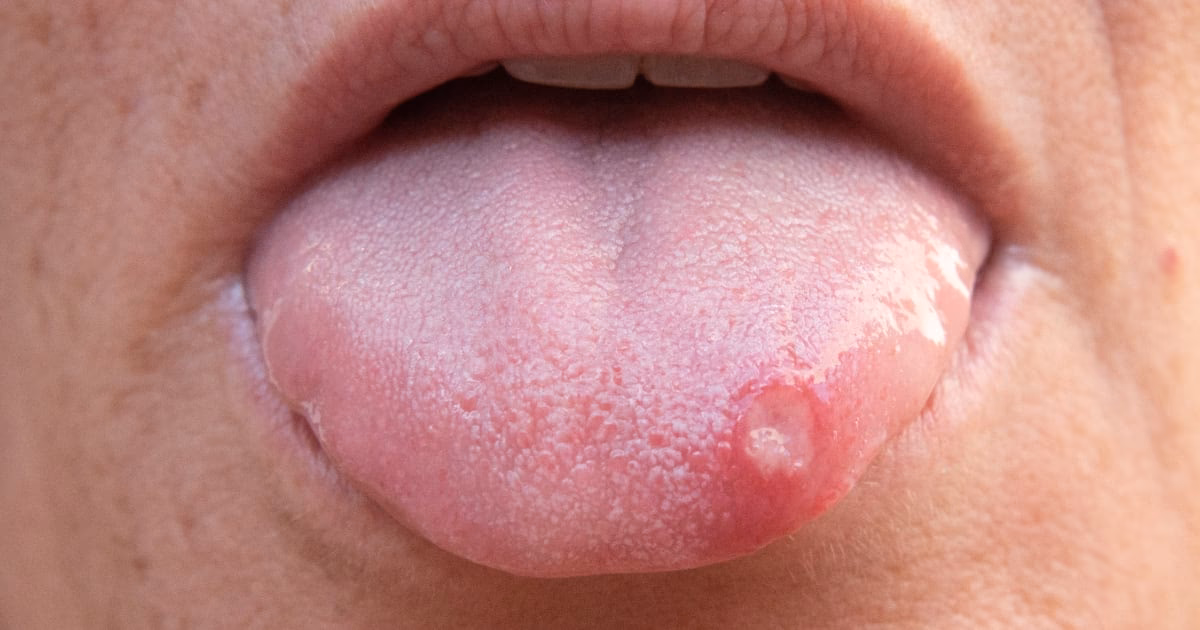 ¿Qué significa que te salgan aftas en la lengua?