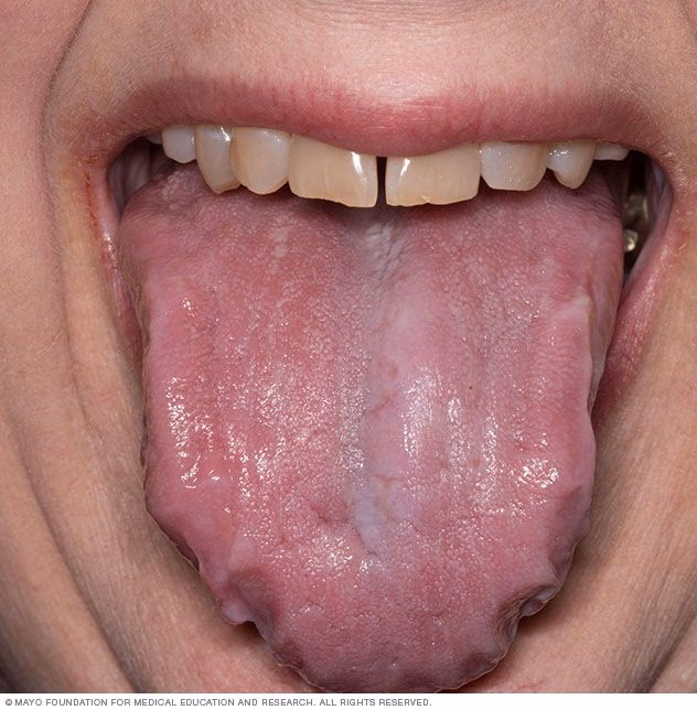 ¿Qué suplementos reducen la amiloidosis?