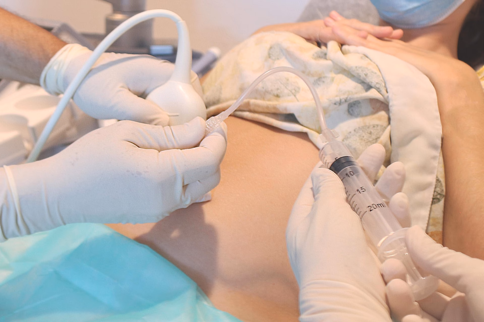 Can acupuncture help with low amniotic fluid?