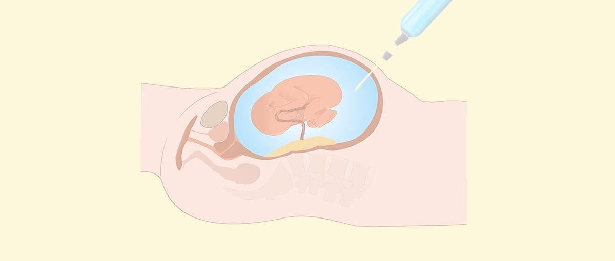 What is the biggest risk of amniocentesis?