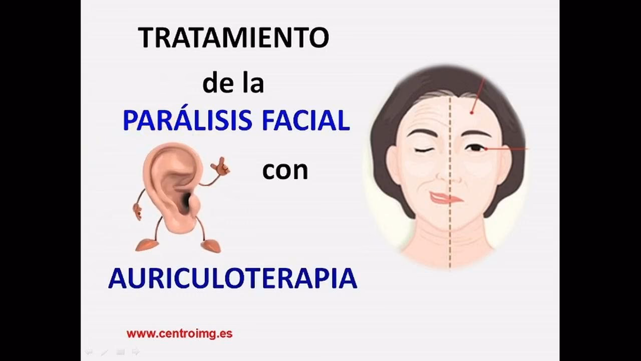 ¿Qué ejercicios son buenos para la parálisis de Bell?