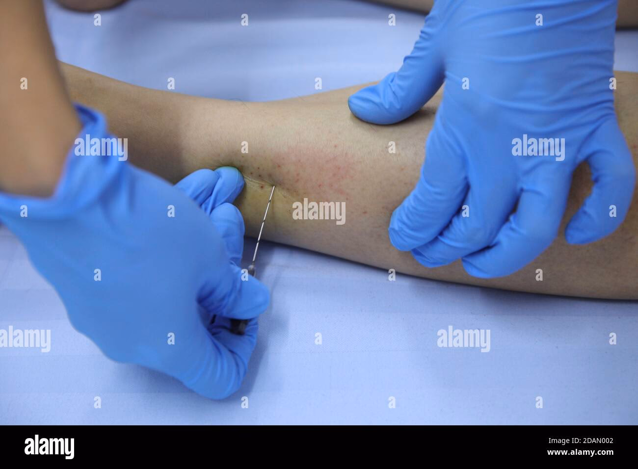 What is catgut in acupuncture?