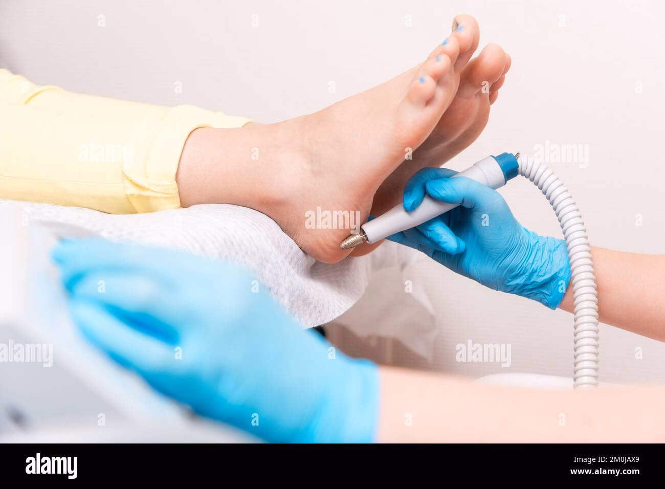 What is more effective, cupping or acupuncture?