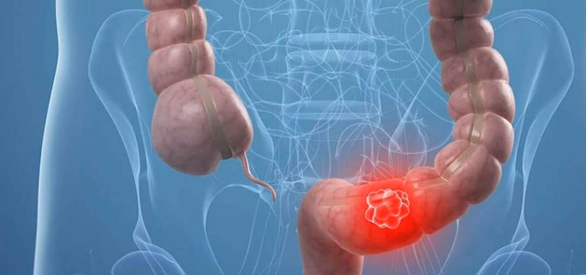 ¿Qué terapia es buena para el colon irritable?