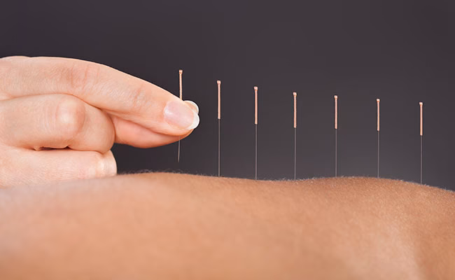 ¿Qué es acupuntura en inglés?