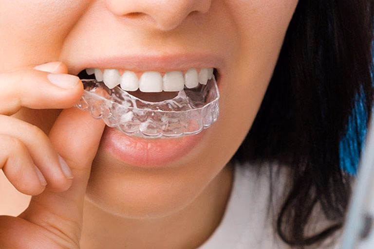 ¿Qué son los dientes desalineados?