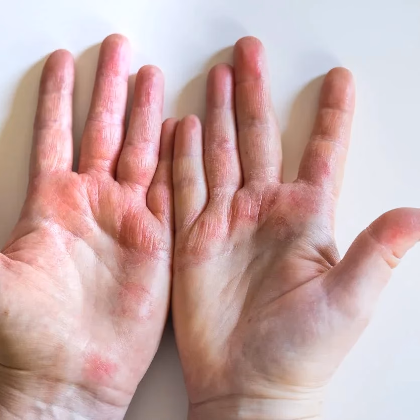 ¿Cómo eliminar definitivamente la dishidrosis?