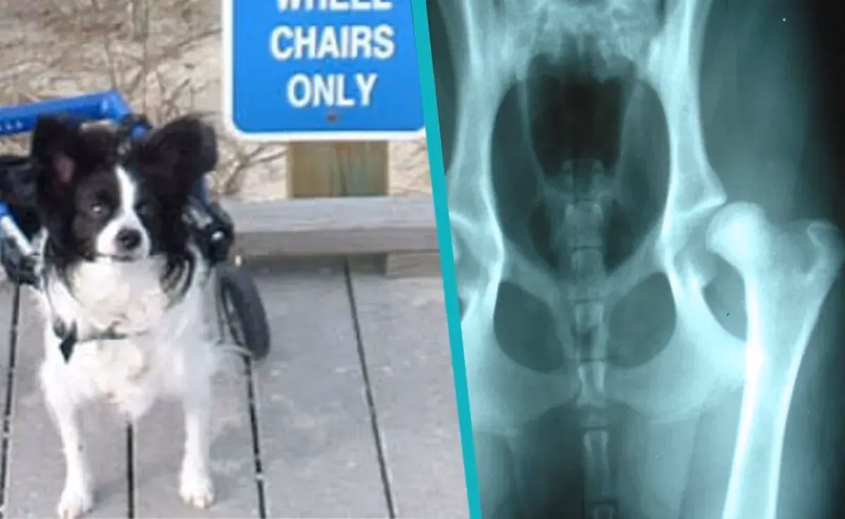 ¿Cómo se corrige la displasia de cadera?