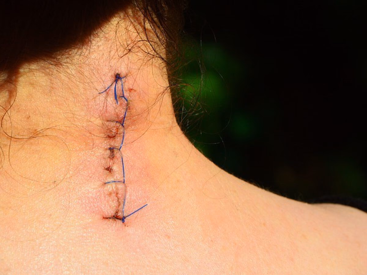 ¿La acupuntura ayuda con el dolor postoperatorio?