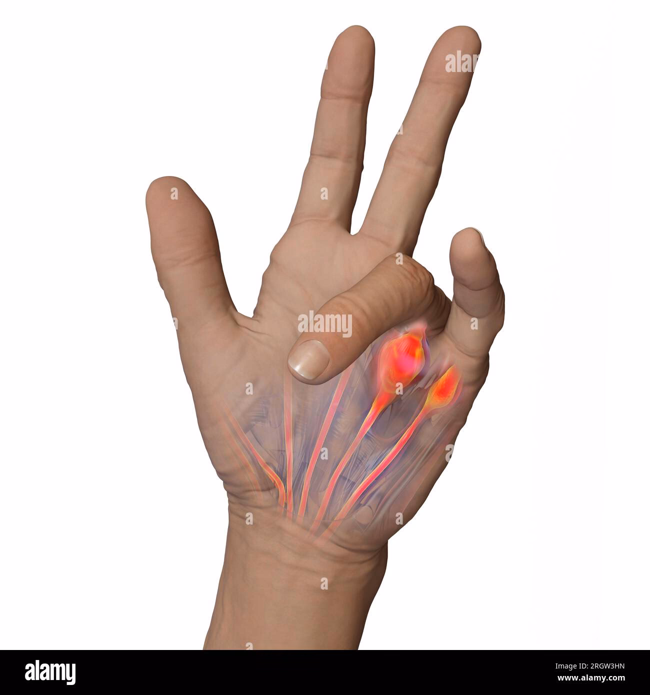 What is the life expectancy of someone with Dupuytren's disease?