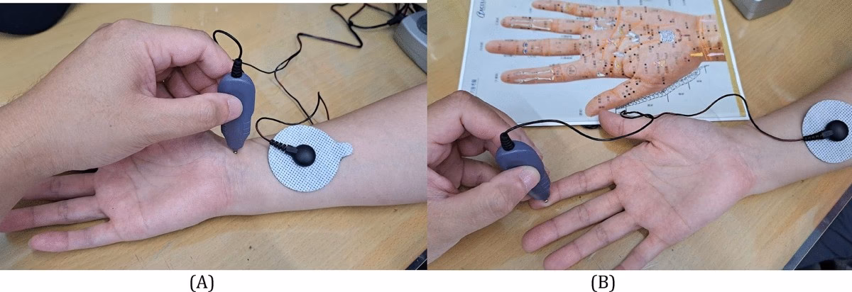 What is the theory of electroacupuncture?