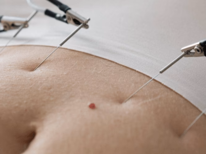¿Qué tan efectiva es la electrolipolisis?