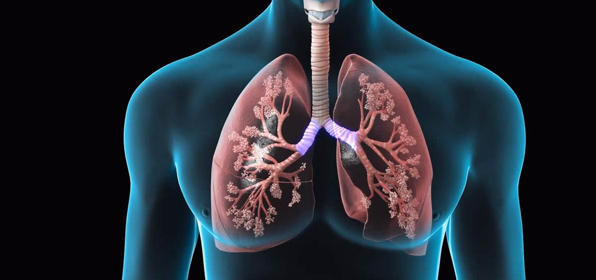 ¿Qué es bueno para la enfermedad pulmonar obstructiva?