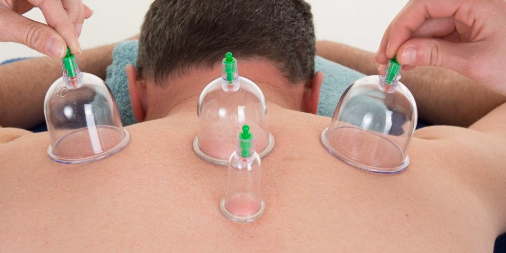 ¿Es mejor hacer ventosas antes o después de la acupuntura?