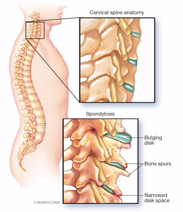¿Qué empeora la espondilosis?