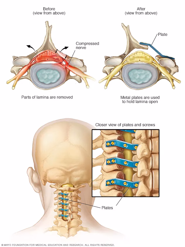 ¿La acupuntura ayuda con la estenosis espinal cervical?