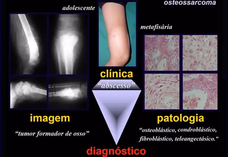 ¿Por qué se origina el osteosarcoma?