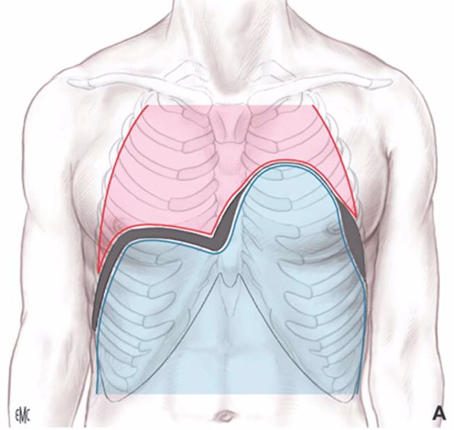 ¿Qué pasa si se paraliza el diafragma?