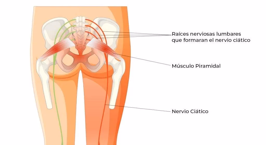 ¿Cómo quitar la falsa ciática?