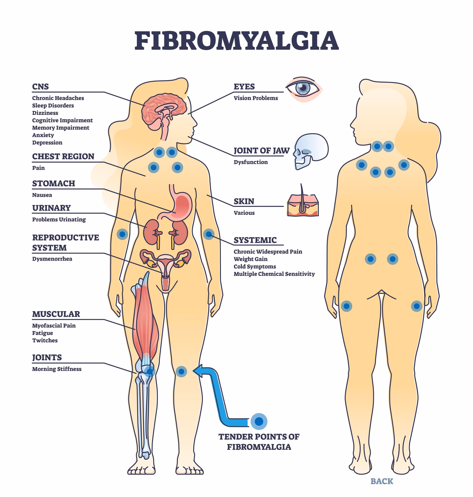 Is fibromyalgia a hypochondriac?