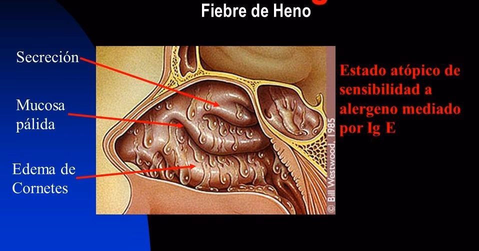 ¿Puede la acupuntura ayudar con la fiebre del heno?