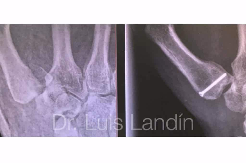 ¿Qué es la luxofractura de Bennett?