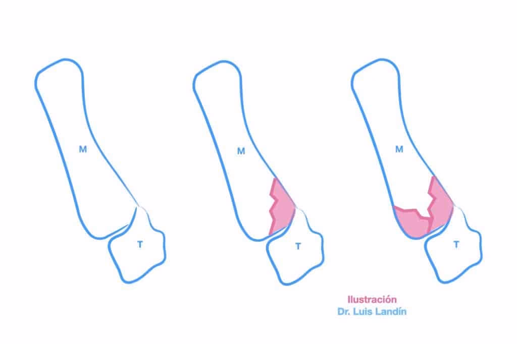 ¿Cómo reducir una fractura de fémur?