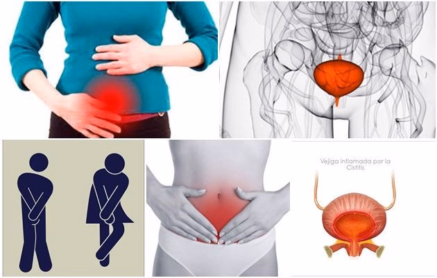 ¿Es la Gardnerella una ETS?