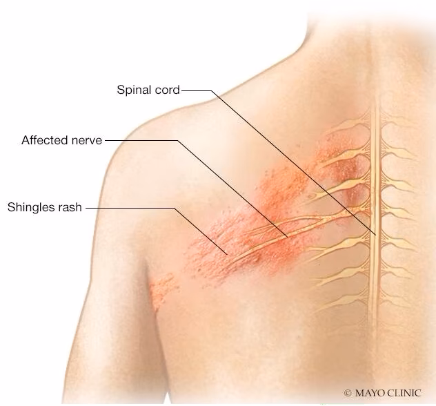 Can you get acupuncture if you have herpes?